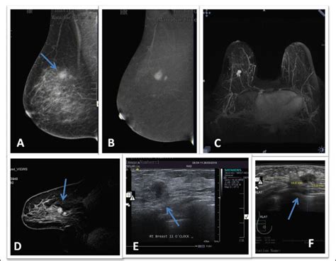 A Year Old Lady Presenting With An Enlarging Right Breast Lump A