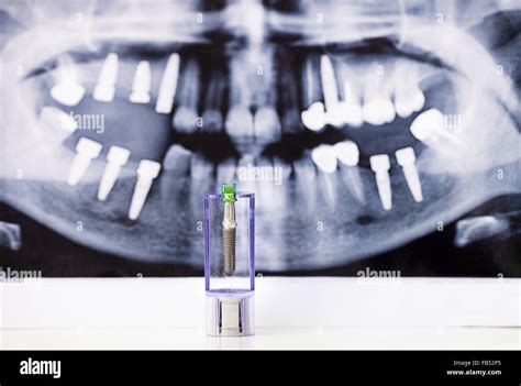 Impianto Dentale E Radiografia Del Dente Come Baground Foto Stock Alamy