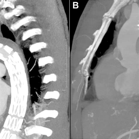 A Computed Tomography Angiography Cta Of The Chest Abdomen And