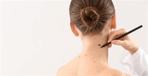 Understanding The Difference Between Beauty Marks And Mole Clinikally