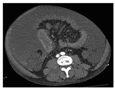 Hemorrhagic Complications of Paracentesis: Aberrant Anatomy ...