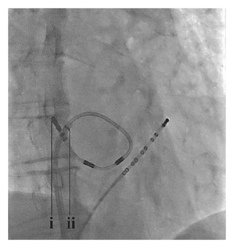 Fluoroscopic Views In Anteroposterior Projection Showing The Special