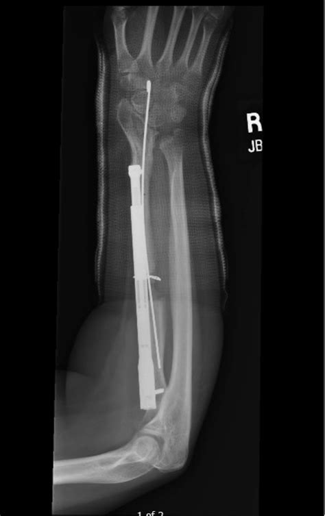 AAHS Correction Of Madelung Deformity Using Internal Distraction