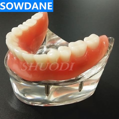 Dental Overdenture Interior Mandibular Lower With 4 Implant Restoration