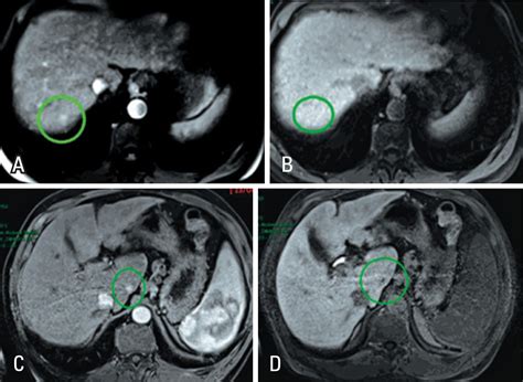 Scielo Brasil Liver Specific Magnetic Resonance Contrast Medium In