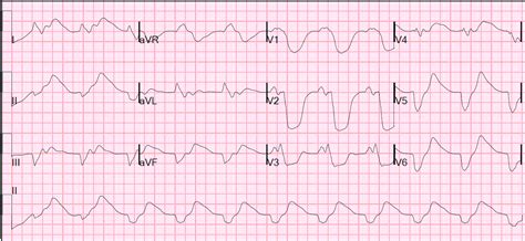 Dr. Smith's ECG Blog: Complaint of Weakness. Alert. Hemodynamically ...