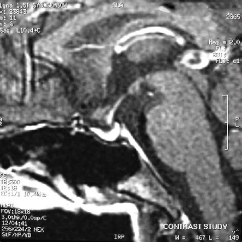 Magnetic Resonance Imaging Showing Partially Empty Sella Download Scientific Diagram