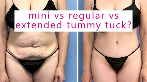 The Difference Between Mini Tummy Tuck Tummy Tuck And Extended Tummy