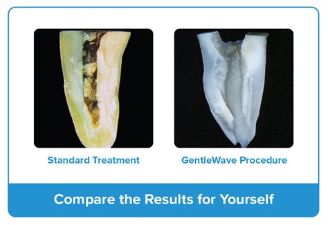 Endodontist Largo Fl Endodontics