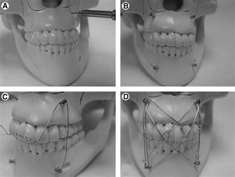 Techniques Of Maxillarymandibular Fixation Operative Techniques In