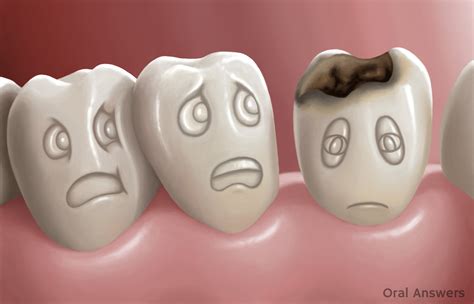 Tooth Decay A Serious Disease Oral Answers