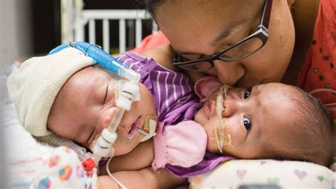 Texas Conjoined Twins Await Surgery To Lead Separate Lives Abc News