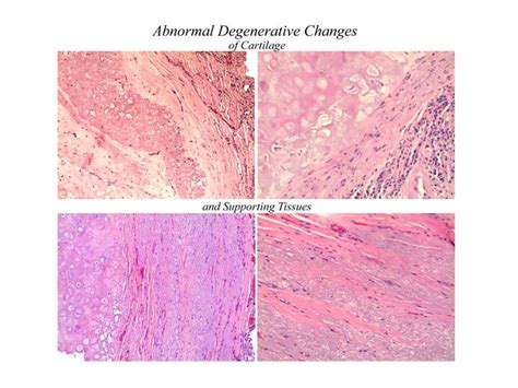 CASE AT A GLANCE: Partial Epiglottis Removal After Tongue Cancer ...