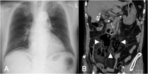 Preoperative Radiological Findings A Radiography Showed Free Free