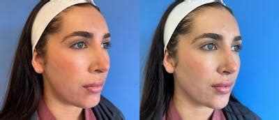 Jawline Contouring Before & After Photos | CosmetiCare