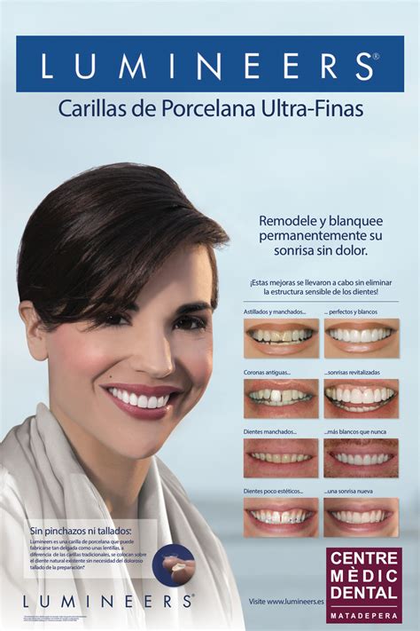 Llegan Las Nuevas Carillas Lumineers Centro Dental Matadepera