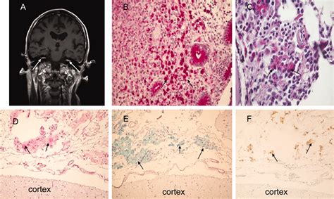 Neoplastic Meningitis As The Presenting Manifestation Of Gastric Adenocarcinoma Bmj Case Reports