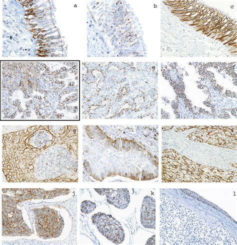 Distinct Claudin Expression Profile In Histologic Subtypes Of Lung