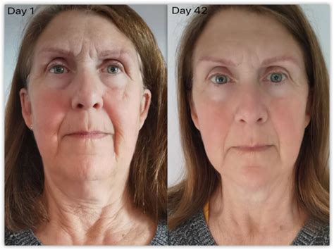 Collagen Before And After Pictures Do You See The Difference