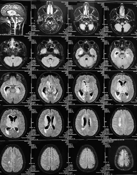 MRI showing hydrocephalus, periventricular oedema and leukoaraiosis. | Download Scientific Diagram