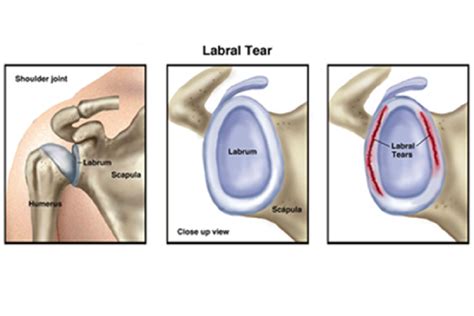 How Serious Is A Torn Labrum For A Baseball Pitcher - BaseBall Wall