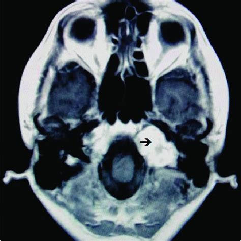 A Preoperative Gadolinium Enhanced Magnetic Resonance Imaging