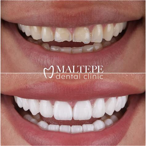 How Much Are Veneers Near San Antonio Tx At Tommie Chagnon Blog