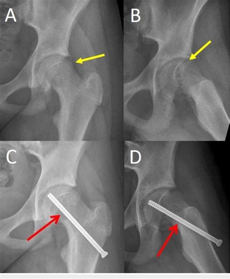 Stable SCFE of the left hip of a 13-year-old girl and in situ... | Download Scientific Diagram