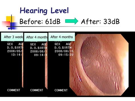 PPT - Innovative regenerative treatment for the tympanic membrane ...