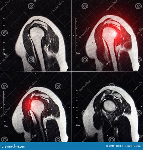 Mri Image Of The Shoulder Joint After A Fracture And Dislocation