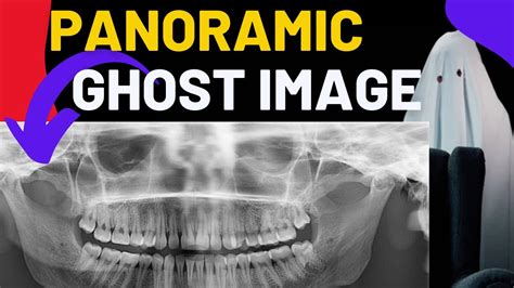 Panoramic Radiographs Ghost Image Principles Of Panaromic Radiography