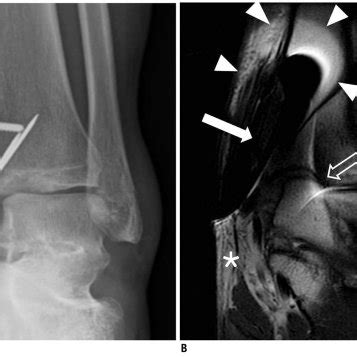 Forms Of Metallic Artifacts Caused By Metallic Hardware In Left Ankle