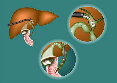 EUS Guided Hepaticogastrostomy