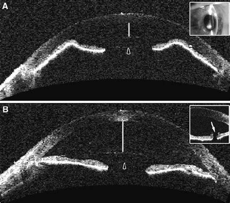 Panel A Shows Slit Lamp Adapted Optical Coherence Tomography 15 Mm