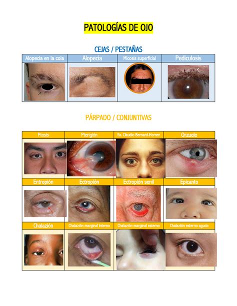 Cuadro de Patologías de Ojo con imágenes PATOLOGÍAS DE OJO CEJAS