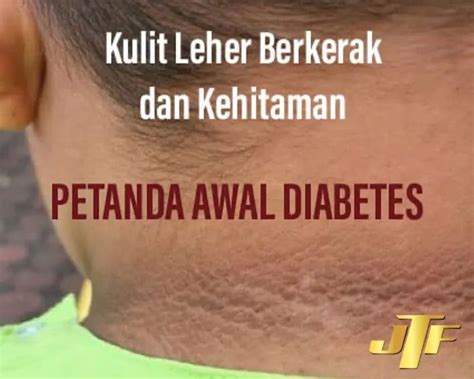 Ini Petanda Kencing Manis Yang Perlu Anda Pantau Pengetahuan