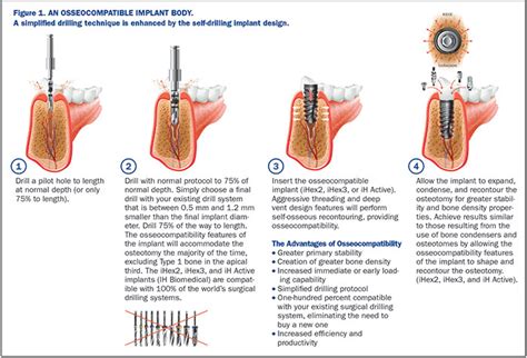 Implant And Prosthetic Efficiency Breakthroughs Recent Advances In Implant Design And Drilling