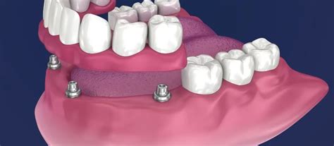 Implantes Dent Rios Pr Tese Overdenture Solu O Est Vel