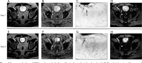 Figure 1 From Ultra Small Superparamagnetic Iron Oxide Contrast Agents