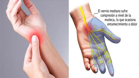 Sindrome Del Tunel Carpiano Archivos Cirugia De Columna En Matamoros