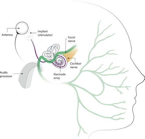 Clinical Management Of Facial Stimulation In Cochlear Implants