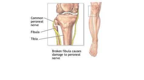 Common Peroneal Nerve