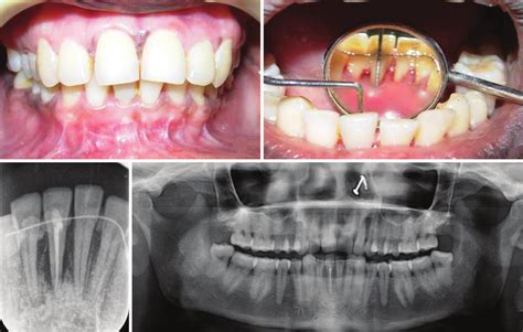 A D Postoperative Clinical And Radiographic Pictures After Months