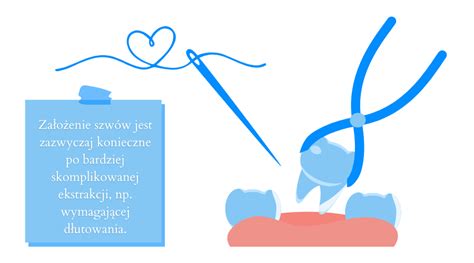 Kiedy Zak Ada Si Szwy Po Wyrwaniu Z Ba Ekstrakcja Z Szyciem Dentinfo