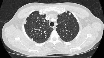 Lung Metastasis Case 002 LITFL Lung Ultrasound Library