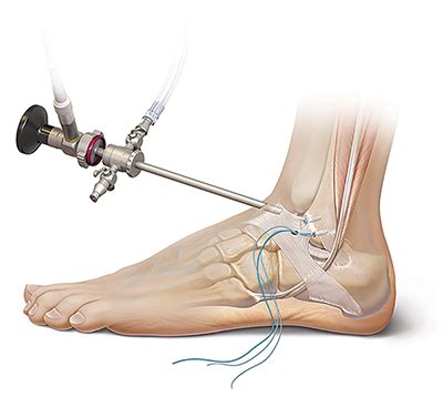 Ankle Ligament Surgery in Singapore | Orion Ortho