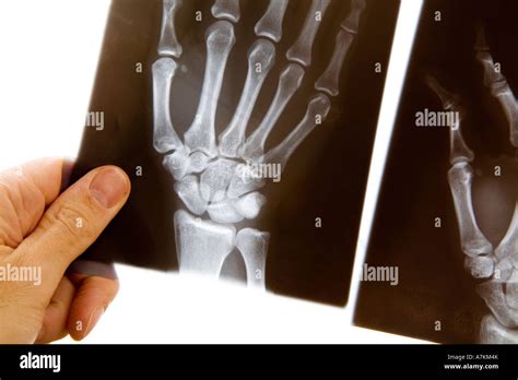 A Male Doctor Holds Up An X Ray Of A Hand To Examine It Stock Photo Alamy