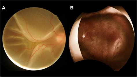 Late Vitreoretinal Complications Of Regressed Retinopathy Of