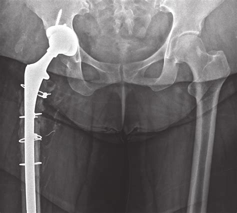 Postoperative x-ray image: revision of the femoral stem and fixation of ...