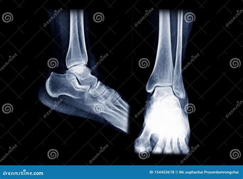 X Ray Image Of Right Ankle Joint AP And Lateral View Stock Photo